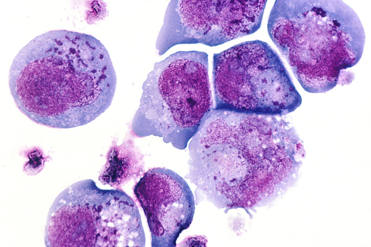 An image of cells infected with human herpes virus-6.