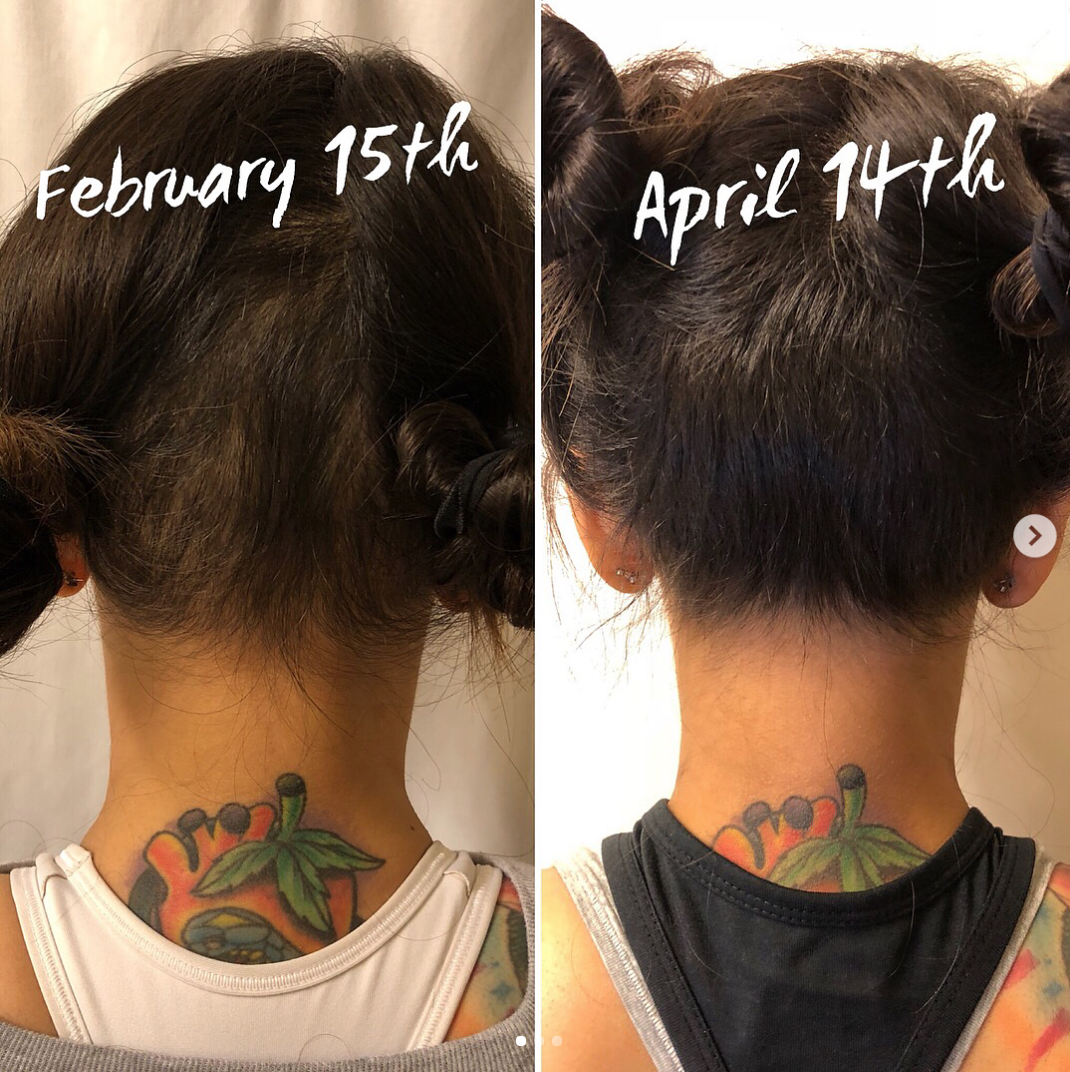 hair regrowth after cold cap