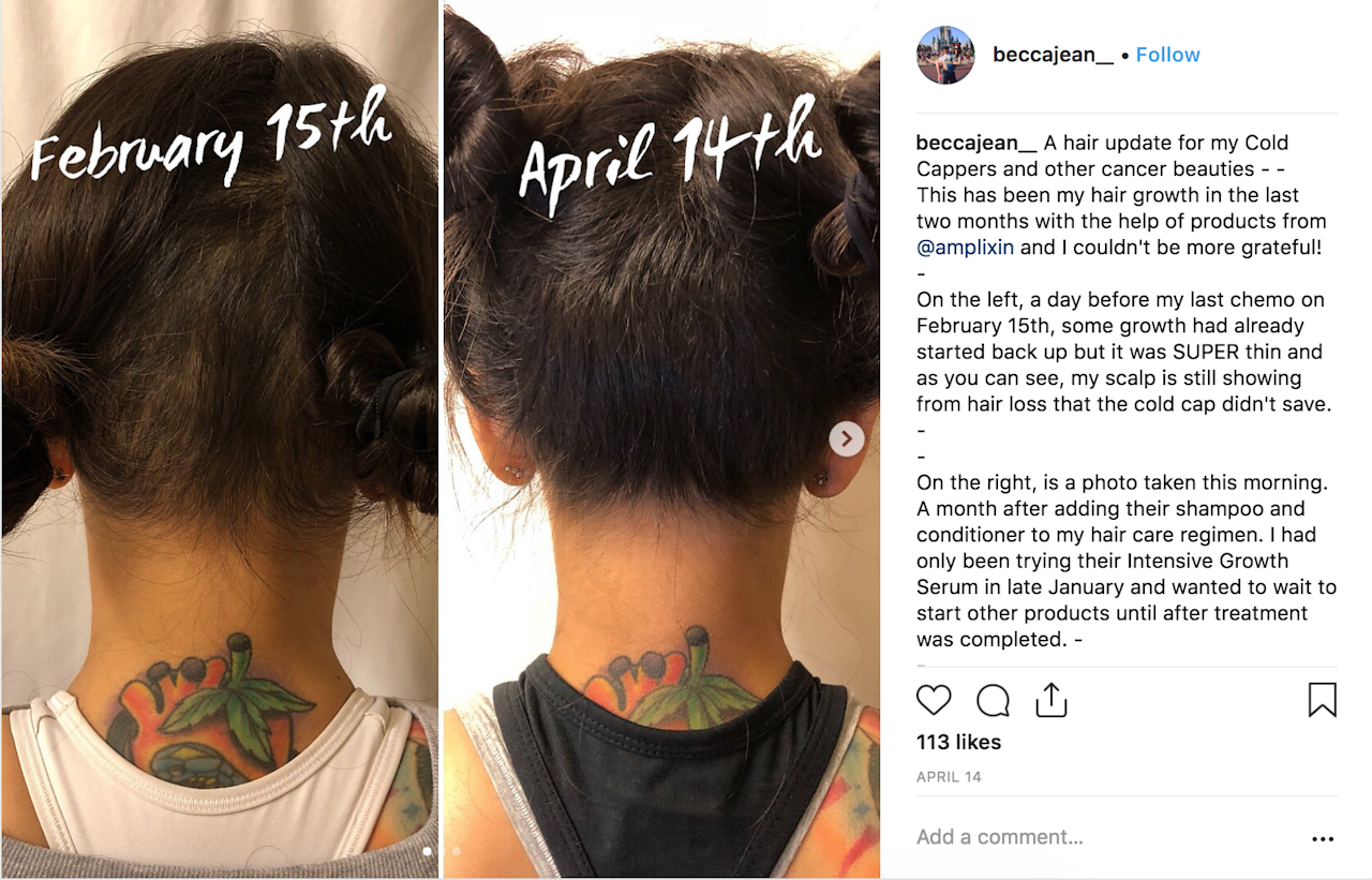 “A hair update for my Cold Cappers and other cancer beauties - - This has been my hair growth in the last two months with the help of products from @amplixin and I couldn't be more grateful!”